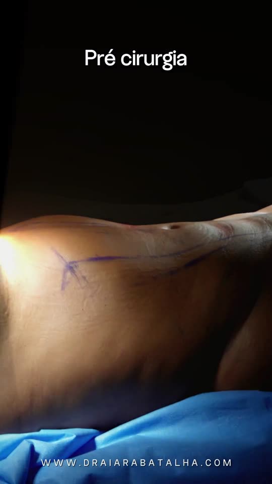 Revisão de lipoaspiração com Vaser e Argoplasma: Lipo feita dez anos antes que a paciente queria refazer: o abdômen antes e o abdômen mais uniforme depois.