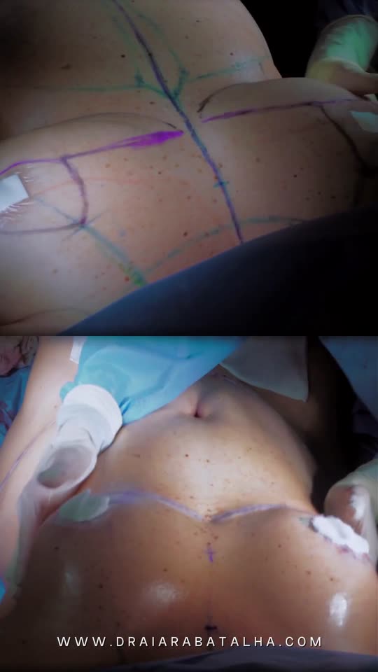 Mastopexia sem prótese, abdominoplastia e lipo de cintura: Paciente de 60 anos que emagreceu quase 20 kg, com o antes e o depois.