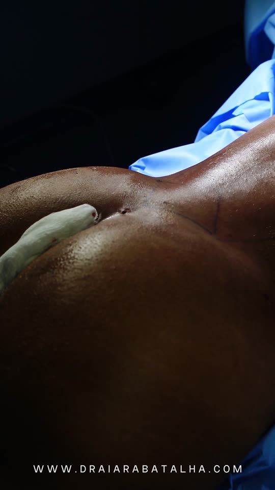 Lipo de flancos e cintura: A cintura desenhada no fim da lipo de flancos, com o antes e depois na tela.