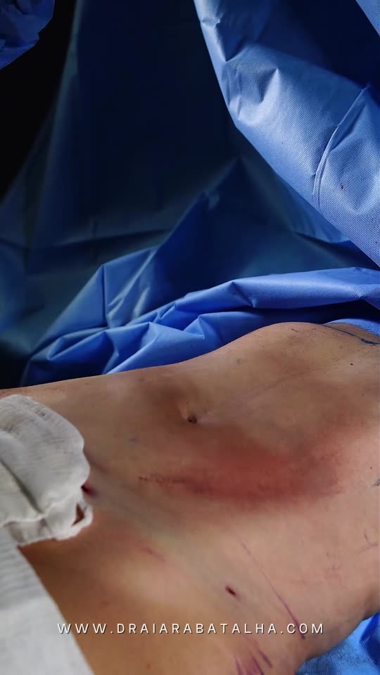 Lipo de abdômen com Argoplasma: Argoplasma só no lado esquerdo, puxando os dois lados com a mesma força.