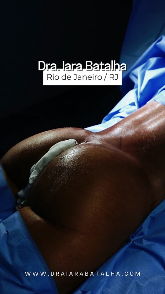 Lipo de flancos: O realce do bumbum com a lipo dos flancos, no fim da cirurgia.