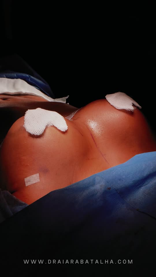 Lipo 360 com mastopexia com prótese: Mama e contorno operados no mesmo dia, no fim da cirurgia.