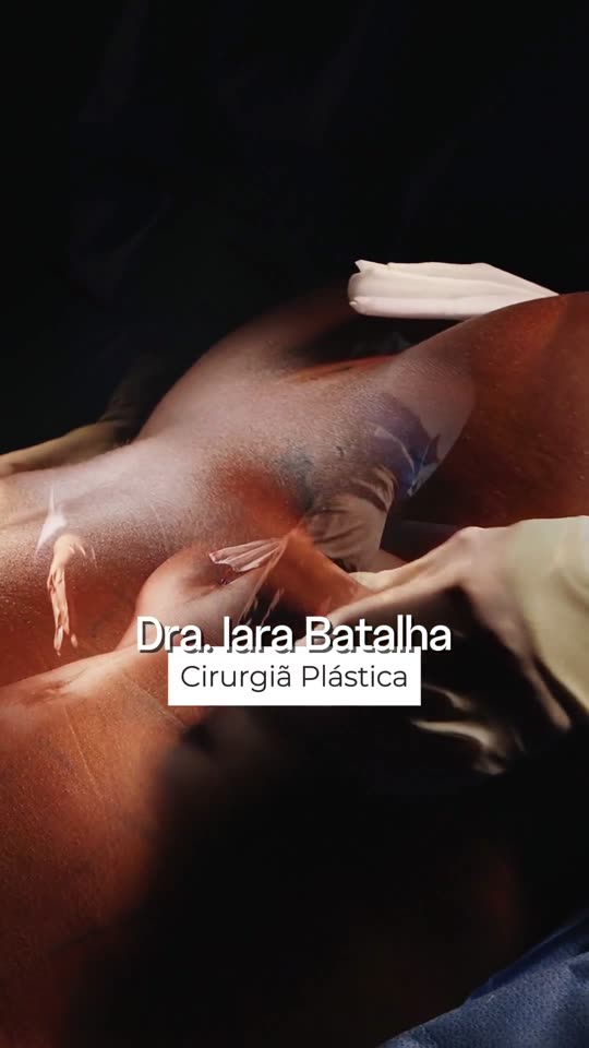 Mastopexia com prótese e lipo 360: Paciente de 56 anos que treina e joga futevôlei: o caso apresentado e o corpo no fim da cirurgia.