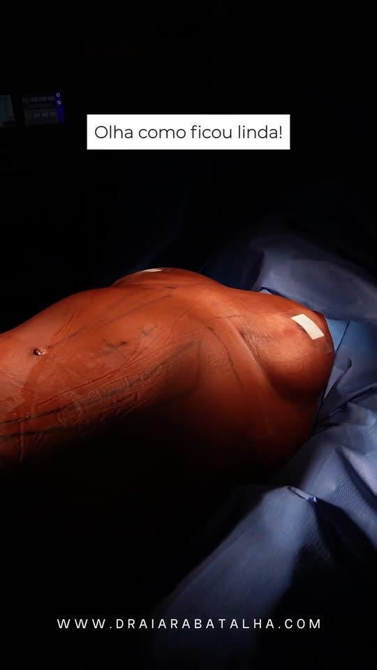 Mastopexia com prótese e lipo 360: Existe idade máxima para operar? A paciente de 56 anos e o resultado no fim do vídeo.