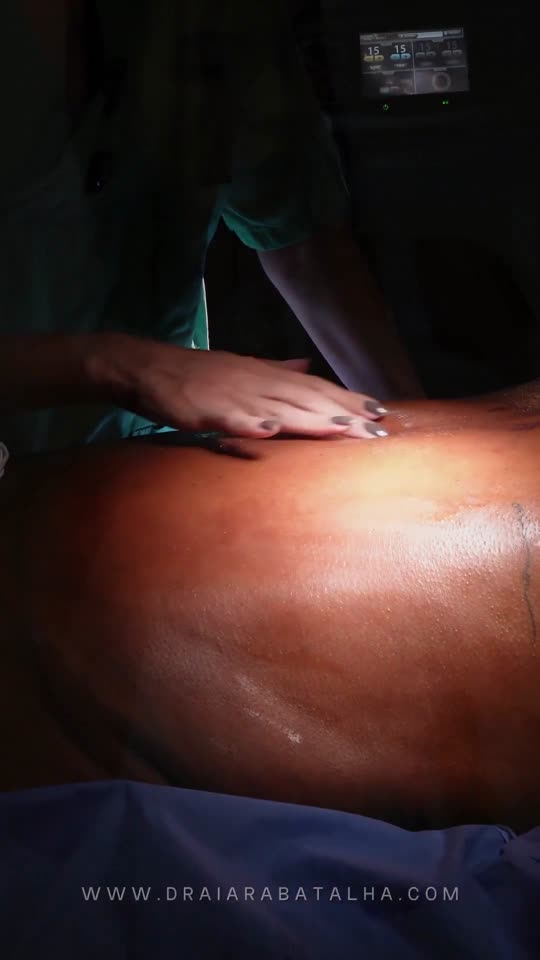 Mastopexia secundária com prótese: Mastopexia refeita anos depois da primeira cirurgia, com o colo no fim da cirurgia.
