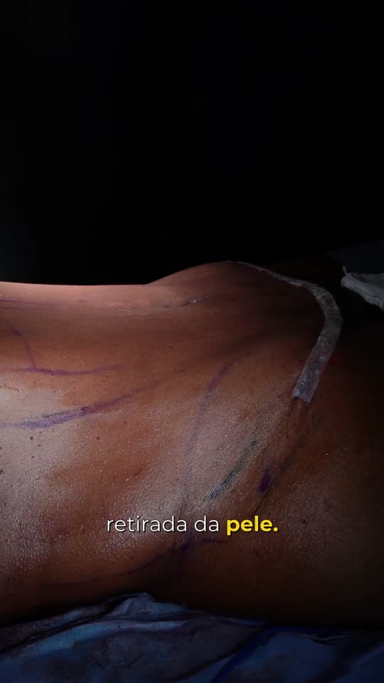 Abdominoplastia sem mexer no umbigo, com lipo: Flacidez moderada e uma paciente que não queria mudar o umbigo: o antes e o resultado.