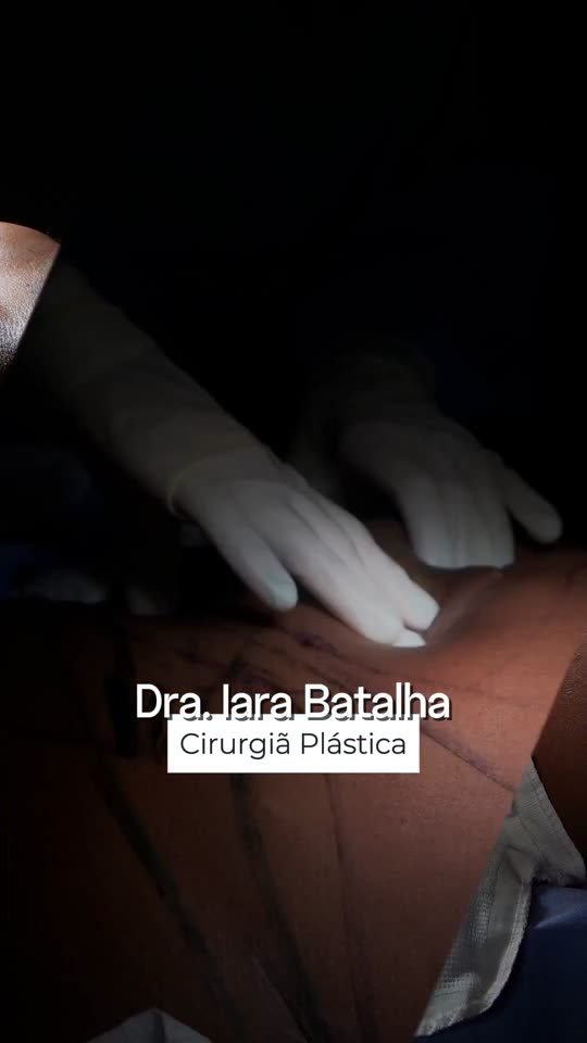 Miniabdominoplastia com plicatura e mastopexia sem prótese: Ela pagou aos poucos, tirou férias e marcou a data: o vídeo termina no antes e depois do abdômen e da mama.