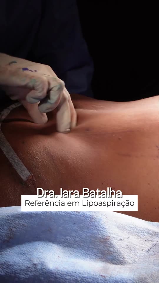 Mastopexia sem prótese, miniabdominoplastia e abdômen reverso: A pele do abdômen retirada pela incisão da mama e pelo miniabdômen, com o resultado no fim.