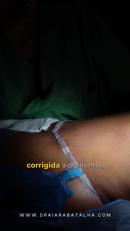 Lipo depois da abdominoplastia: Paciente que já tinha feito abdominoplastia e ainda sentia gordura e orelhinhas laterais: mais de 1 litro retirado.