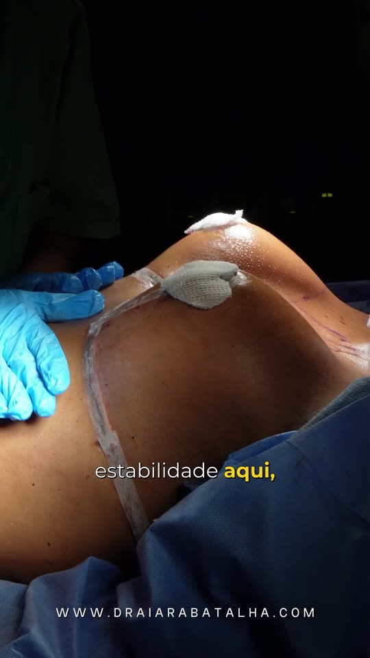 Mastopexia com sutiã interno: As queixas da paciente e a estabilidade da mama no fim da cirurgia, com o sutiã interno.