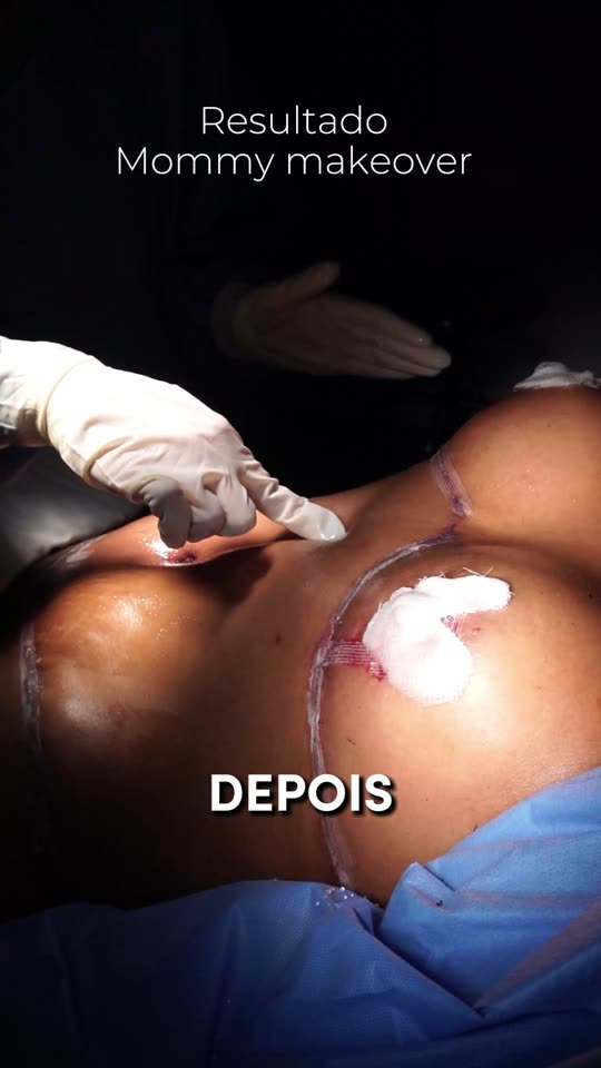 Mommy makeover: Antes e depois lado a lado, com o corpo no fim da cirurgia.