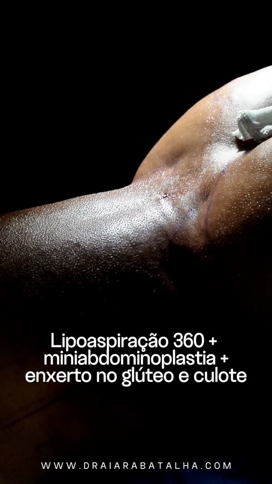 Lipo 360, miniabdominoplastia e enxerto no glúteo e no culote: Mais marcada ou menos marcada? A conversa da marcação e o resultado no próprio vídeo.