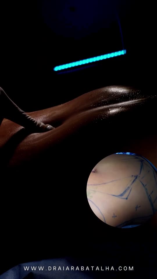 Lipo com tecnologia de retração de pele: A flacidez depois de tirar 2,2 litros e a pele depois da tecnologia de retração.