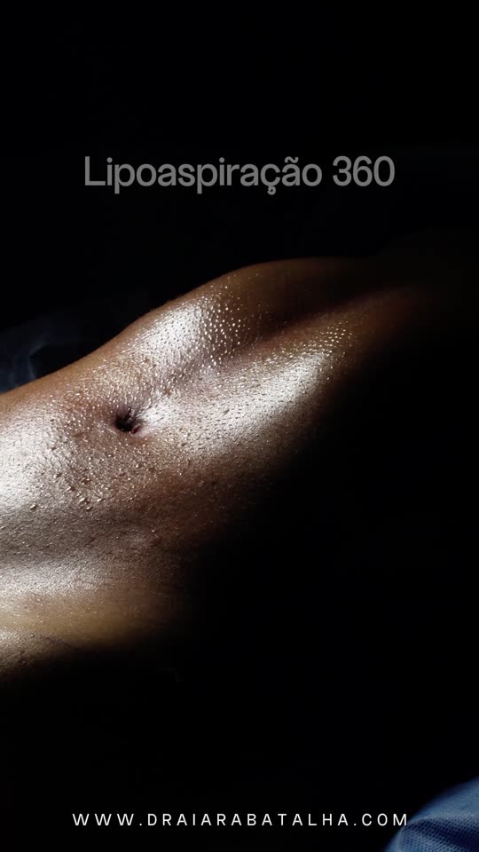 Lipo 360: A marcação e o abdômen definido no fim da cirurgia.