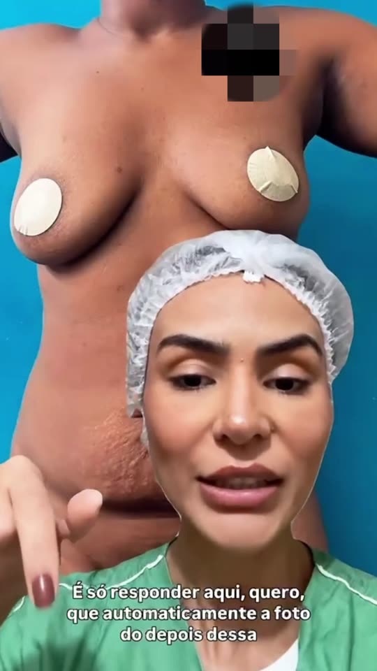Abdominoplastia depois da gestação: Para quem tem medo da cicatriz e do novo umbigo: a silhueta da paciente depois da abdominoplastia.