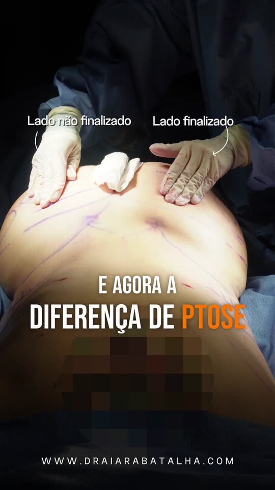 Enxerto de gordura no glúteo: A bananinha do bumbum: o lado finalizado e o lado ainda não finalizado.