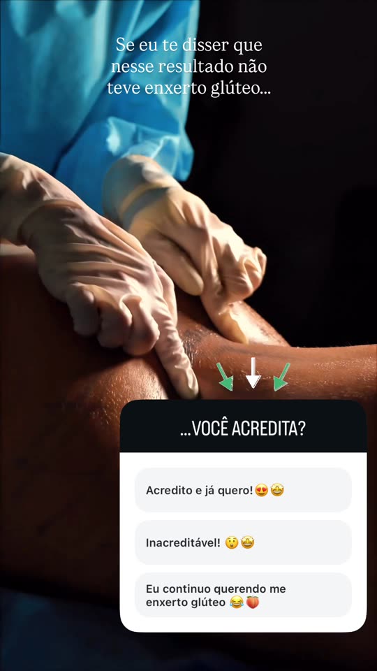 Lipo 360: O contorno do glúteo e da cintura depois da lipo 360, com a enquete: você acredita que não teve enxerto?