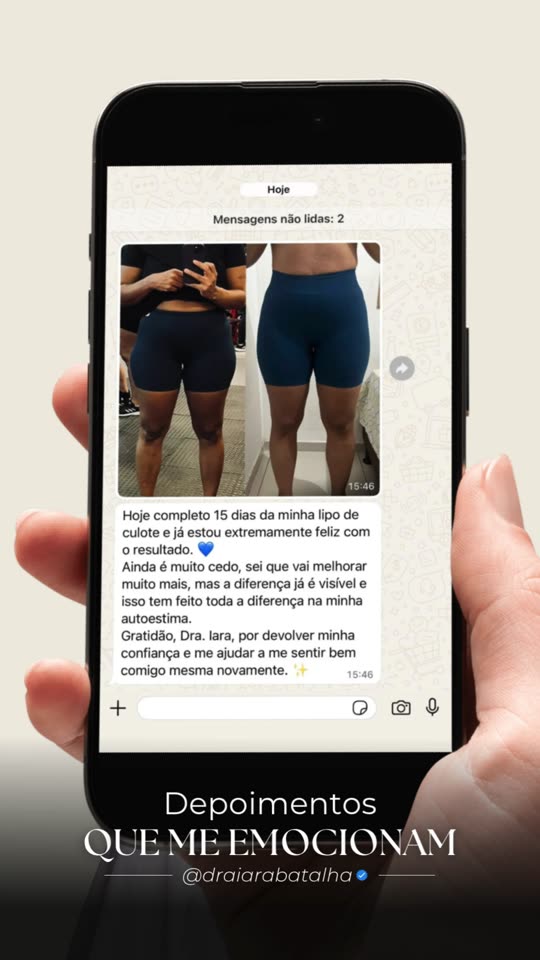 Lipo de culote: O depoimento da paciente com a foto de antes e depois que ela mesma mandou.