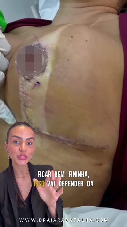 Mastopexia: A retirada da cola 21 dias depois da mastopexia, com o antes e depois da aréola e da cicatriz.