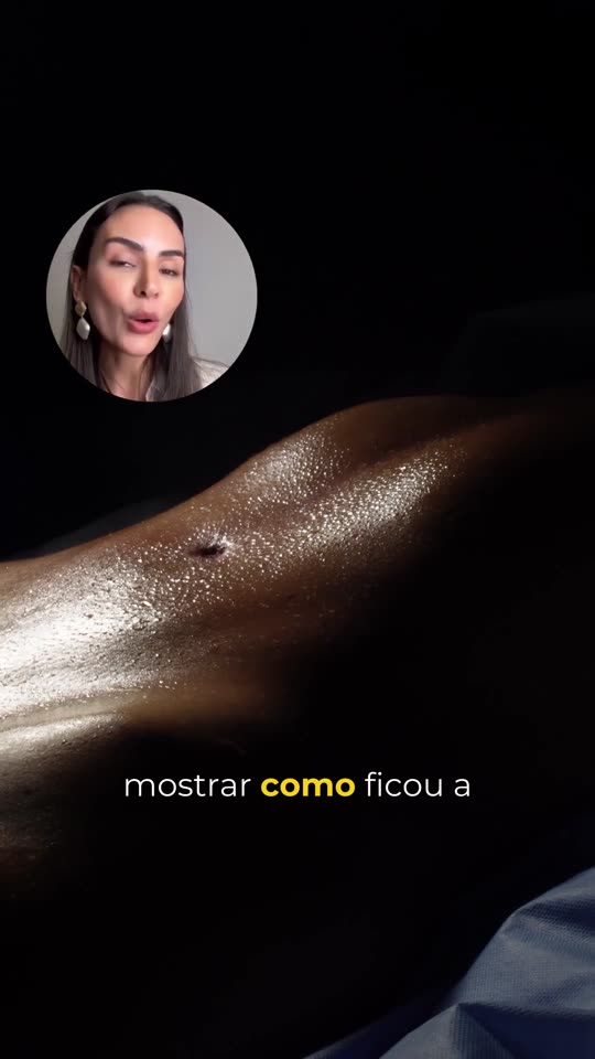 Lipo de abdômen: A foto de inspiração que a paciente mandou pelo WhatsApp e como ficou a lipo dela.