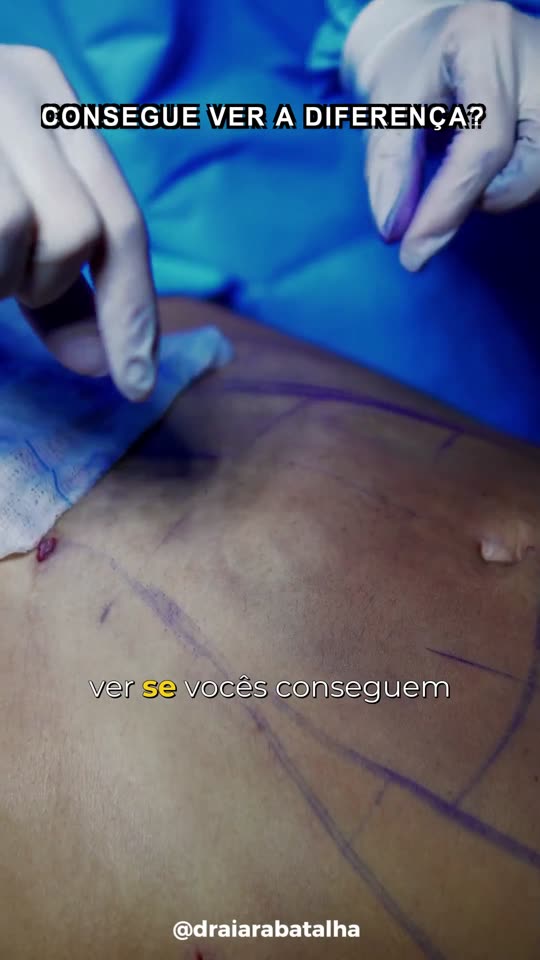 Lipoaspiração com retração de pele: Depois de tirar quase 2 litros, o lado com a tecnologia de retração comparado ao lado sem.