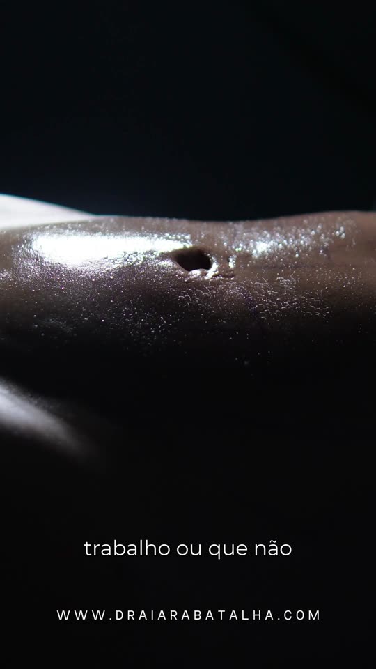 Lipo de abdômen: Paciente operada de manhã, indo para casa no mesmo dia, com o antes e depois do abdômen.
