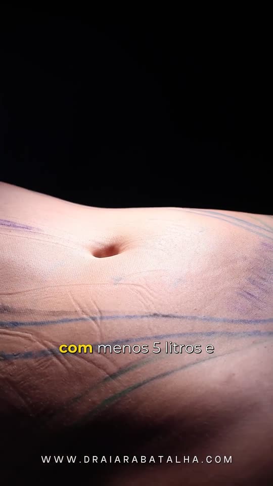 Lipo 360: Paciente alta e musculosa, com 5,4 litros de gordura retirados: o antes e depois da cintura.