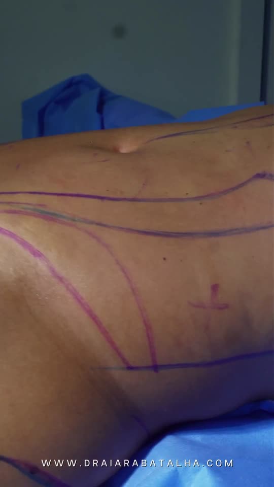 Lipo de abdômen com enxerto no glúteo: Queixa de gordura ao redor do umbigo e de pouca projeção do glúteo: o antes, a cirurgia e o depois.