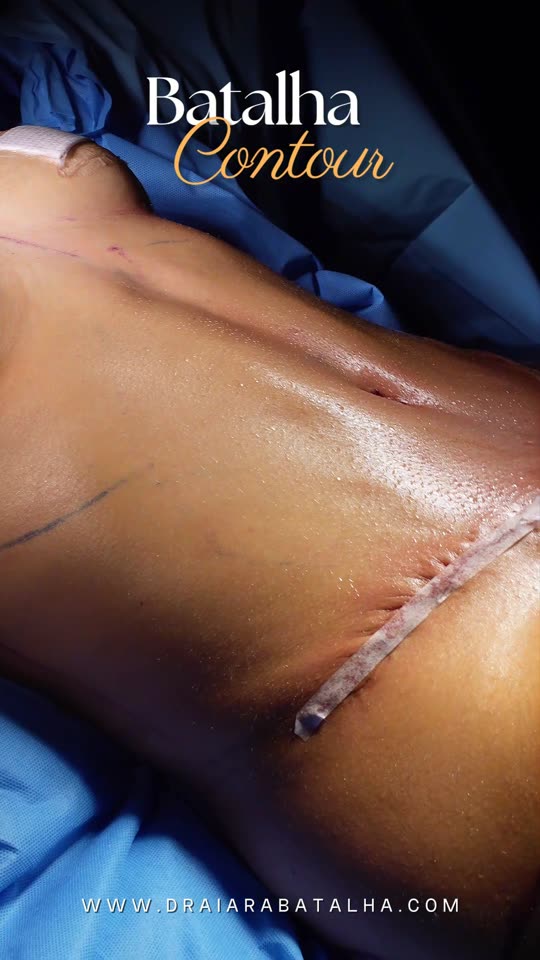 Lipo com abdominoplastia: Do desenho da marcação ao abdômen fechado.