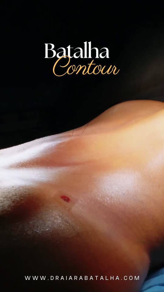Lipo 360 com enxerto no glúteo: A marcação e o contorno no fim da cirurgia.