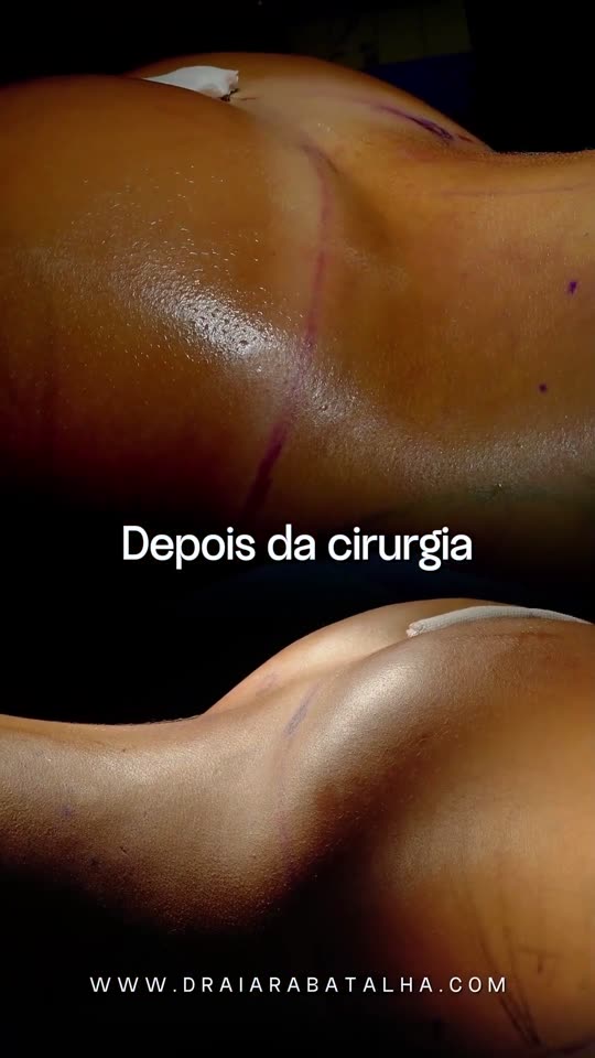 Lipo 360, enxerto no glúteo e correção de diástase por vídeo: Lipo 360 com enxerto no glúteo, diástase corrigida por vídeo e Argoplasma, com o corpo no fim da cirurgia.