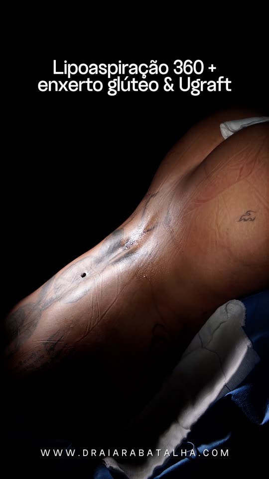 Lipo 360, enxerto no glúteo e Ugraft: A marcação do abdômen e o contorno no fim da cirurgia.