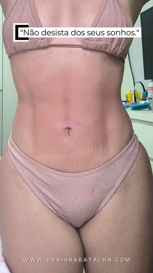 Contorno corporal: O antes e o depois em pé, de lingerie, para quem adiou o sonho de operar.