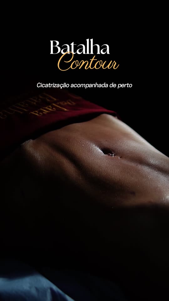 Lipoaspiração: Os quatro pilares do Método Batalha Contour sobre o corpo no fim da cirurgia.