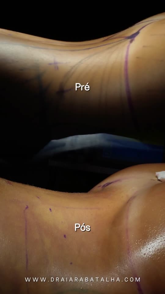 Lipo 360: Por que a cintura começa no dorso, com a cintura aparecendo no fim da cirurgia.