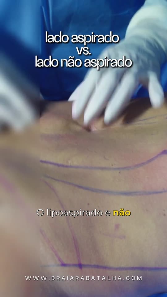 Lipo de abdômen: O lado já aspirado e o lado que ainda não foi, na mesma paciente.
