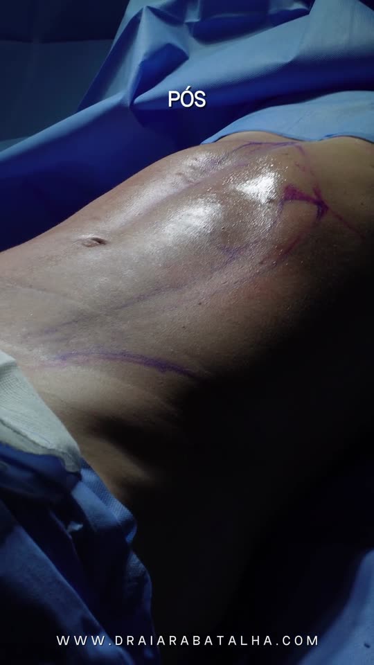 Lipo de abdômen masculina: Paciente homem, magro e treinado: o antes e o pós imediato, com as linhas do abdômen realçadas.