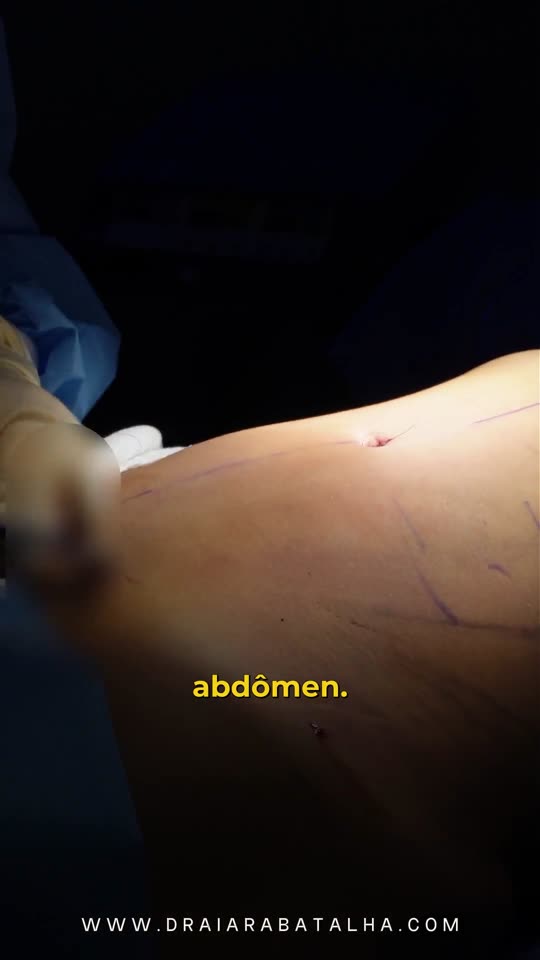 Lipo de dorso e abdômen, MILA e Argoplasma: A pele tratada com Argoplasma comparada à pele ainda não tratada.