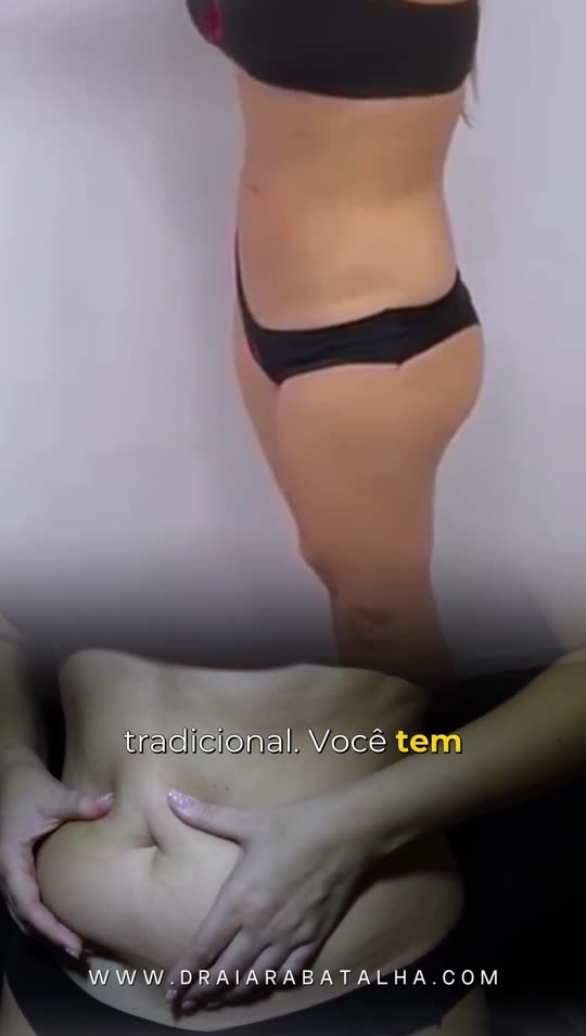 Lipo de abdômen: Retorno com dois meses e meio: a retração da pele e o abdômen de hoje com o antes sobreposto.
